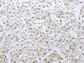 The image on the left is immunohistochemistry of paraffin-embedded Human lung cancer tissue using CSB-PA960924(DNAJC7 Antibody) at dilution 1/25, on the right is treated with fusion protein. (Original magnification: ×200)