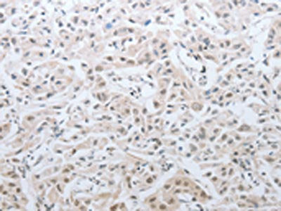 The image on the left is immunohistochemistry of paraffin-embedded Human lung cancer tissue using CSB-PA960924(DNAJC7 Antibody) at dilution 1/25, on the right is treated with fusion protein. (Original magnification: ×200)