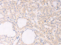 The image on the left is immunohistochemistry of paraffin-embedded Human thyroid cancer tissue using CSB-PA960978(F7 Antibody) at dilution 1/30, on the right is treated with fusion protein. (Original magnification: ×200)