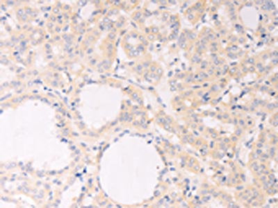 The image on the left is immunohistochemistry of paraffin-embedded Human thyroid cancer tissue using CSB-PA960978(F7 Antibody) at dilution 1/30, on the right is treated with fusion protein. (Original magnification: ×200)