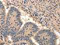 The image on the left is immunohistochemistry of paraffin-embedded Human colon cancer tissue using CSB-PA961022(BAIAP2 Antibody) at dilution 1/50, on the right is treated with fusion protein. (Original magnification: ×200)