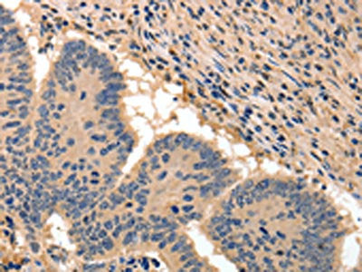 The image on the left is immunohistochemistry of paraffin-embedded Human colon cancer tissue using CSB-PA961022(BAIAP2 Antibody) at dilution 1/50, on the right is treated with fusion protein. (Original magnification: ×200)
