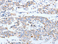 The image on the left is immunohistochemistry of paraffin-embedded Human breast cancer tissue using CSB-PA961180(ARF4 Antibody) at dilution 1/20, on the right is treated with fusion protein. (Original magnification: ×200)
