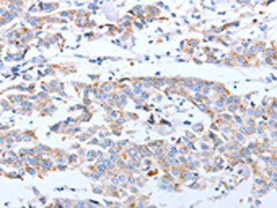 The image on the left is immunohistochemistry of paraffin-embedded Human breast cancer tissue using CSB-PA961180(ARF4 Antibody) at dilution 1/20, on the right is treated with fusion protein. (Original magnification: ×200)