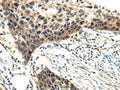 The image on the left is immunohistochemistry of paraffin-embedded Human esophagus cancer tissue using CSB-PA961371(EFNA3 Antibody) at dilution 1/20, on the right is treated with fusion protein. (Original magnification: ×200)