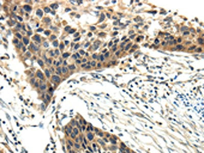 The image on the left is immunohistochemistry of paraffin-embedded Human esophagus cancer tissue using CSB-PA961371(EFNA3 Antibody) at dilution 1/20, on the right is treated with fusion protein. (Original magnification: ×200)