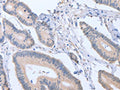 The image on the left is immunohistochemistry of paraffin-embedded Human colon cancer tissue using CSB-PA961708(ACVR1C Antibody) at dilution 1/15, on the right is treated with fusion protein. (Original magnification: ×200)