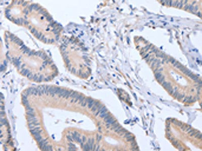 The image on the left is immunohistochemistry of paraffin-embedded Human colon cancer tissue using CSB-PA961708(ACVR1C Antibody) at dilution 1/15, on the right is treated with fusion protein. (Original magnification: ×200)