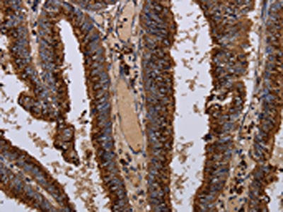 The image on the left is immunohistochemistry of paraffin-embedded Human colon cancer tissue using CSB-PA961944(PPP1R1B Antibody) at dilution 1/50, on the right is treated with fusion protein. (Original magnification: ×200)
