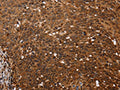 The image on the left is immunohistochemistry of paraffin-embedded Human cervical cancer tissue using CSB-PA962118(FANCF Antibody) at dilution 1/60, on the right is treated with fusion protein. (Original magnification: ×200)