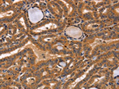 The image on the left is immunohistochemistry of paraffin-embedded Human thyroid cancer tissue using CSB-PA962305(CCL23 Antibody) at dilution 1/50, on the right is treated with synthetic peptide. (Original magnification: ×200)