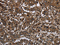 The image on the left is immunohistochemistry of paraffin-embedded Human liver cancer tissue using CSB-PA962337(GLIPR1 Antibody) at dilution 1/50, on the right is treated with fusion protein. (Original magnification: ×200)