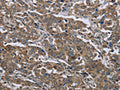 The image on the left is immunohistochemistry of paraffin-embedded Human liver cancer tissue using CSB-PA962996(GGCX Antibody) at dilution 1/50, on the right is treated with fusion protein. (Original magnification: ×200)
