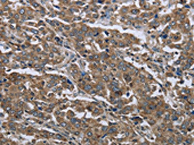 The image on the left is immunohistochemistry of paraffin-embedded Human liver cancer tissue using CSB-PA962996(GGCX Antibody) at dilution 1/50, on the right is treated with fusion protein. (Original magnification: ×200)