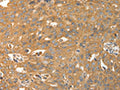 The image on the left is immunohistochemistry of paraffin-embedded Human ovarian cancer tissue using CSB-PA963019(CALR Antibody) at dilution 1/30, on the right is treated with fusion protein. (Original magnification: ×200)