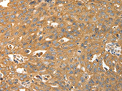 The image on the left is immunohistochemistry of paraffin-embedded Human ovarian cancer tissue using CSB-PA963019(CALR Antibody) at dilution 1/30, on the right is treated with fusion protein. (Original magnification: ×200)