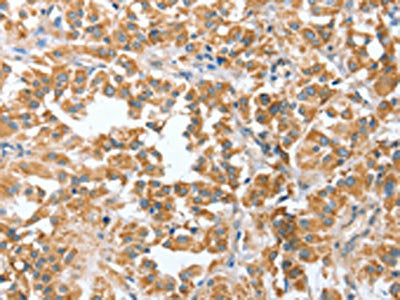 The image on the left is immunohistochemistry of paraffin-embedded Human thyroid cancer tissue using CSB-PA963186(CIAPIN1 Antibody) at dilution 1/60, on the right is treated with fusion protein. (Original magnification: ×200)