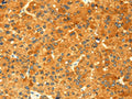The image on the left is immunohistochemistry of paraffin-embedded Human liver cancer tissue using CSB-PA963389(GK Antibody) at dilution 1/60, on the right is treated with fusion protein. (Original magnification: ×200)