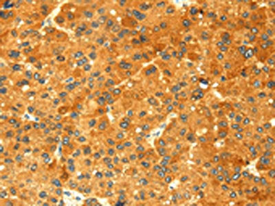 The image on the left is immunohistochemistry of paraffin-embedded Human liver cancer tissue using CSB-PA963389(GK Antibody) at dilution 1/60, on the right is treated with fusion protein. (Original magnification: ×200)