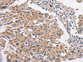 The image on the left is immunohistochemistry of paraffin-embedded Human lung cancer tissue using CSB-PA963449(MAPK15 Antibody) at dilution 1/20, on the right is treated with fusion protein. (Original magnification: ×200)