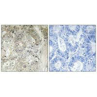 Immunohistochemistry analysis of paraffin-embedded human colon carcinoma tissue using CST1 antibody.