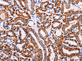 The image on the left is immunohistochemistry of paraffin-embedded Human thyroid cancer tissue using CSB-PA963716(AGTR2 Antibody) at dilution 1/15, on the right is treated with synthetic peptide. (Original magnification: ×200)