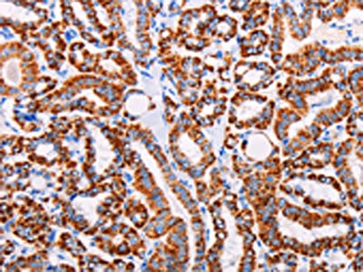 The image on the left is immunohistochemistry of paraffin-embedded Human thyroid cancer tissue using CSB-PA963716(AGTR2 Antibody) at dilution 1/15, on the right is treated with synthetic peptide. (Original magnification: ×200)