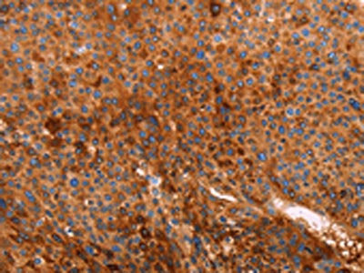 The image on the left is immunohistochemistry of paraffin-embedded Human liver cancer tissue using CSB-PA964049(GC Antibody) at dilution 1/40, on the right is treated with fusion protein. (Original magnification: ×200)