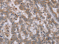 The image on the left is immunohistochemistry of paraffin-embedded Human liver cancer tissue using CSB-PA964117(EPSTI1 Antibody) at dilution 1/40, on the right is treated with fusion protein. (Original magnification: ×200)