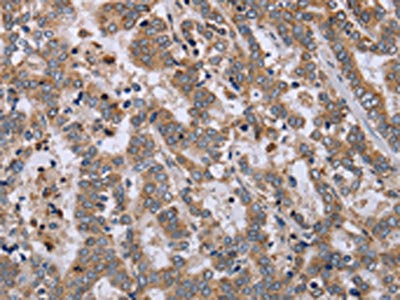 The image on the left is immunohistochemistry of paraffin-embedded Human liver cancer tissue using CSB-PA964117(EPSTI1 Antibody) at dilution 1/40, on the right is treated with fusion protein. (Original magnification: ×200)
