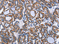 The image on the left is immunohistochemistry of paraffin-embedded Human thyroid cancer tissue using CSB-PA964355(INTS10 Antibody) at dilution 1/50, on the right is treated with fusion protein. (Original magnification: ×200)