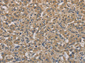 The image on the left is immunohistochemistry of paraffin-embedded Human thyroid cancer tissue using CSB-PA964373(AGTRAP Antibody) at dilution 1/40, on the right is treated with fusion protein. (Original magnification: ×200)