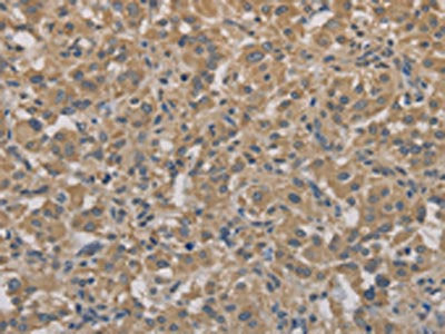 The image on the left is immunohistochemistry of paraffin-embedded Human thyroid cancer tissue using CSB-PA964373(AGTRAP Antibody) at dilution 1/40, on the right is treated with fusion protein. (Original magnification: ×200)