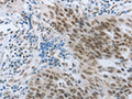 The image on the left is immunohistochemistry of paraffin-embedded Human ovarian cancer tissue using CSB-PA964463(ACIN1 Antibody) at dilution 1/30, on the right is treated with synthetic peptide. (Original magnification: ×200)