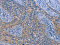 The image on the left is immunohistochemistry of paraffin-embedded Human cervical cancer tissue using CSB-PA964484(NEK8 Antibody) at dilution 1/30, on the right is treated with fusion protein. (Original magnification: ×200)