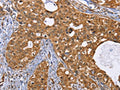 The image on the left is immunohistochemistry of paraffin-embedded Human cervical cancer tissue using CSB-PA964946(IDH1 Antibody) at dilution 1/25, on the right is treated with fusion protein. (Original magnification: ×200)