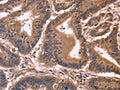 The image on the left is immunohistochemistry of paraffin-embedded Human colon cancer tissue using CSB-PA965050(CCDC106 Antibody) at dilution 1/50, on the right is treated with fusion protein. (Original magnification: ×200)