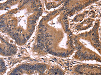 The image on the left is immunohistochemistry of paraffin-embedded Human colon cancer tissue using CSB-PA965050(CCDC106 Antibody) at dilution 1/50, on the right is treated with fusion protein. (Original magnification: ×200)