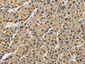 The image is immunohistochemistry of paraffin-embedded Human liver cancer tissue using CSB-PA965093(GAS7 Antibody) at dilution 1/30. (Original magnification: ×200)