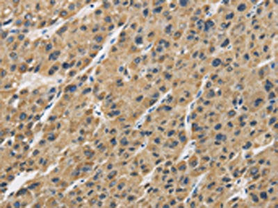 The image is immunohistochemistry of paraffin-embedded Human liver cancer tissue using CSB-PA965093(GAS7 Antibody) at dilution 1/30. (Original magnification: ×200)