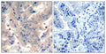Immunohistochemical analysis of paraffin-embedded human lung carcinoma tissue using PI3K P85 a/g/b(Ab-467/199/464) Antibody(left) or the same antibody preincubated with blocking peptide(right).