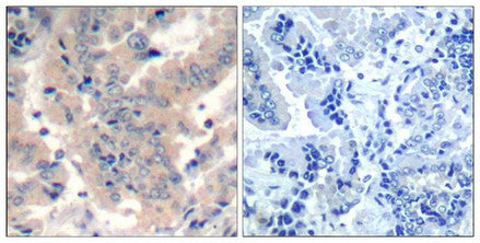 Immunohistochemical analysis of paraffin-embedded human lung carcinoma tissue using PI3K P85 a/g/b(Ab-467/199/464) Antibody(left) or the same antibody preincubated with blocking peptide(right).