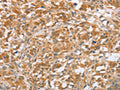 The image on the left is immunohistochemistry of paraffin-embedded Human thyroid cancer tissue using CSB-PA966173(CTAGE5 Antibody) at dilution 1/40, on the right is treated with fusion protein. (Original magnification: ×200)