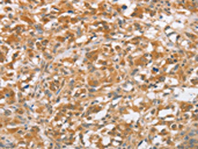The image on the left is immunohistochemistry of paraffin-embedded Human thyroid cancer tissue using CSB-PA966173(CTAGE5 Antibody) at dilution 1/40, on the right is treated with fusion protein. (Original magnification: ×200)