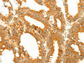 The image on the left is immunohistochemistry of paraffin-embedded Human colon cancer tissue using CSB-PA966330(DIABLO Antibody) at dilution 1/50, on the right is treated with fusion protein. (Original magnification: ×200)