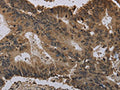 The image on the left is immunohistochemistry of paraffin-embedded Human colon cancer tissue using CSB-PA966398(HIST4H4 Antibody) at dilution 1/30, on the right is treated with fusion protein. (Original magnification: ×200)