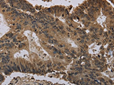 The image on the left is immunohistochemistry of paraffin-embedded Human colon cancer tissue using CSB-PA966398(HIST4H4 Antibody) at dilution 1/30, on the right is treated with fusion protein. (Original magnification: ×200)