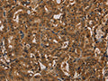 The image on the left is immunohistochemistry of paraffin-embedded Human thyroid cancer tissue using CSB-PA966542(KIF20A Antibody) at dilution 1/20, on the right is treated with fusion protein. (Original magnification: ×200)