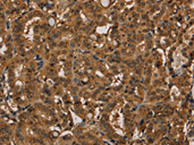 The image on the left is immunohistochemistry of paraffin-embedded Human thyroid cancer tissue using CSB-PA966542(KIF20A Antibody) at dilution 1/20, on the right is treated with fusion protein. (Original magnification: ×200)