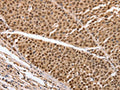 The image on the left is immunohistochemistry of paraffin-embedded Human liver cancer tissue using CSB-PA966699(PARP1 Antibody) at dilution 1/20, on the right is treated with synthetic peptide. (Original magnification: ×200)